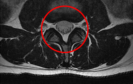 모커리한방병원 MRI로 본 정상적인 척추관 이미지