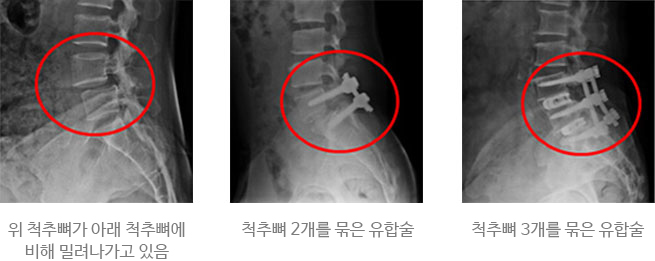 모커리한방병원 위 척추뼈가 아래 척추뼈에 비해 밀려나가고 있는 X-Ray , 척추뼈 2마디를 묶은 유합술 X-Ray , 척추뼈 3마디를 묶은 유합술 X-Ray 이미지