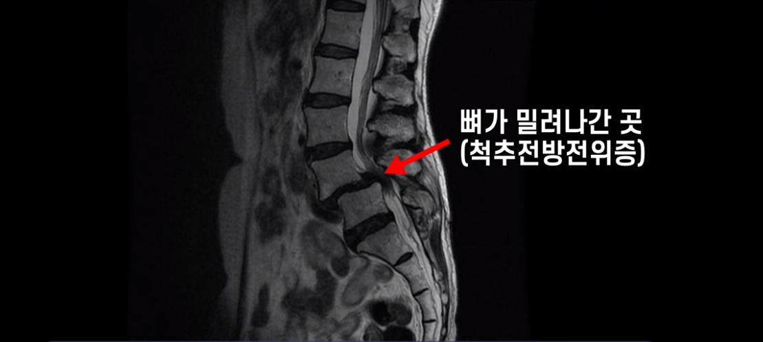 척추전방전위증 엑스레이